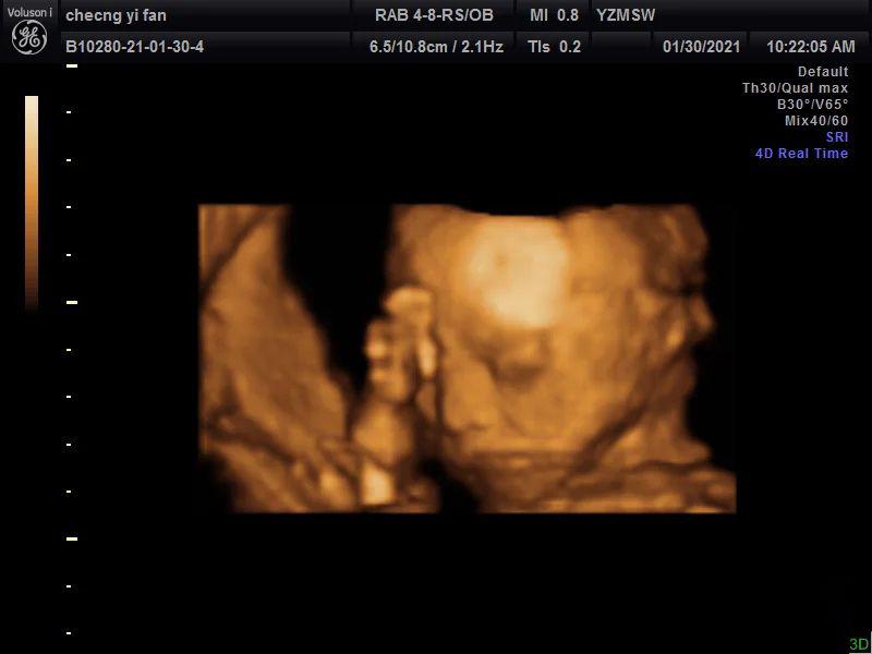 23周做了四维28周还需要再做吗,孕23周四维查出问题还能留吗