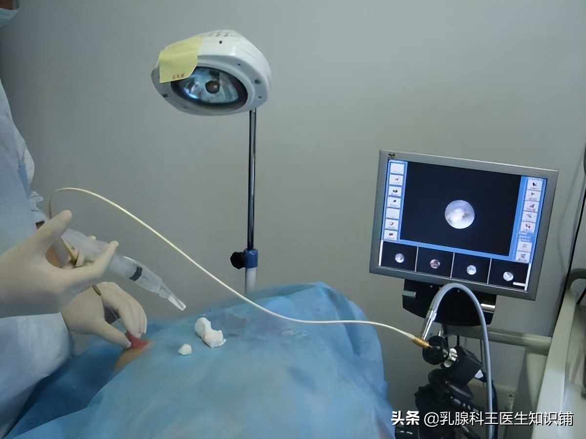 乳头出现溢液你需要进行这些检查、治疗和预防(下)