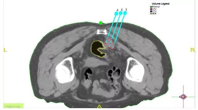 癌症不做化疗新方法细胞疗法,癌症早期不化疗用中药能治好吗