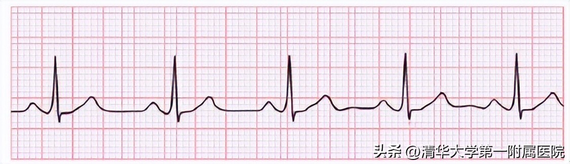 体检心电图报告解读,美年大体检心电图报告
