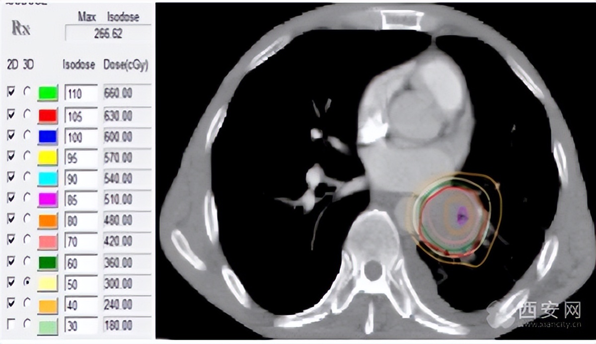 精准放疗能全部杀死癌细胞吗,早期肺癌可以用精准放疗吗