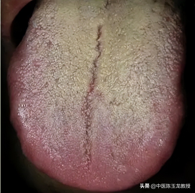 大肠湿热和膀胱湿热吃什么中成药,脾胃湿热和肝胆湿热同治的中成药