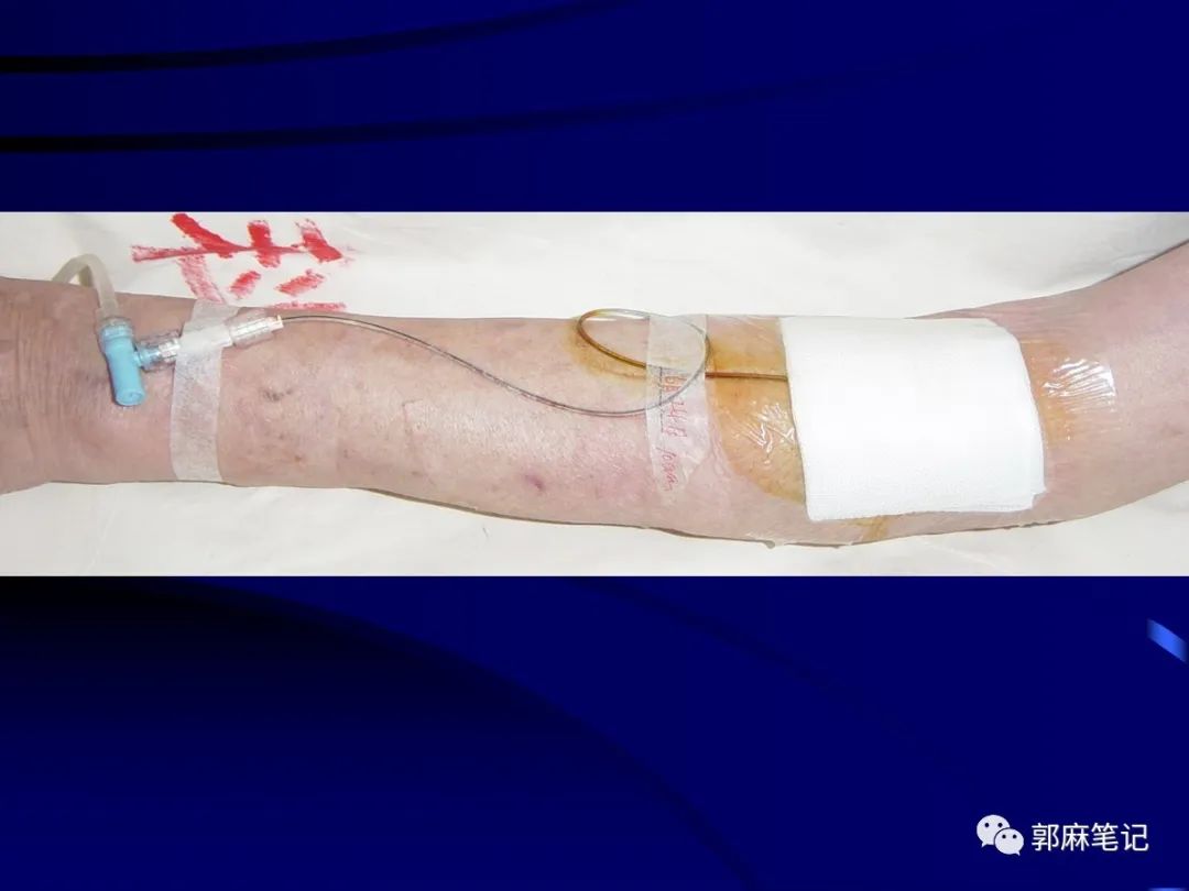 中心静脉穿刺置管术ppt免费,中心静脉置管的护理ppt