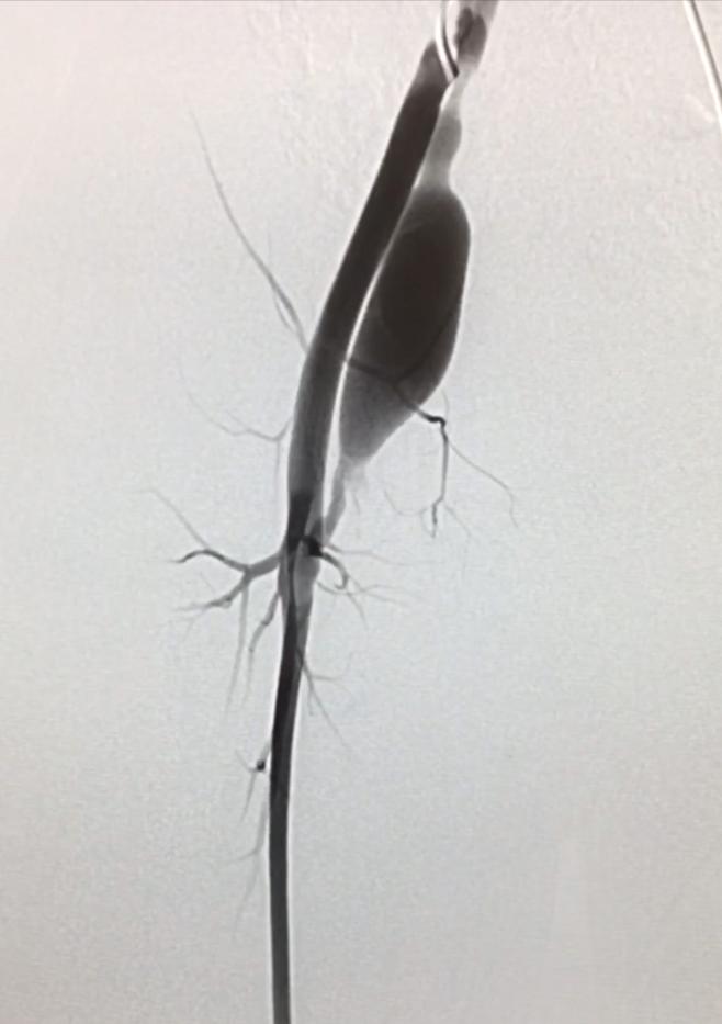 血管畸形伴大静脉瘤扩张,下肢动静脉畸形介入治疗