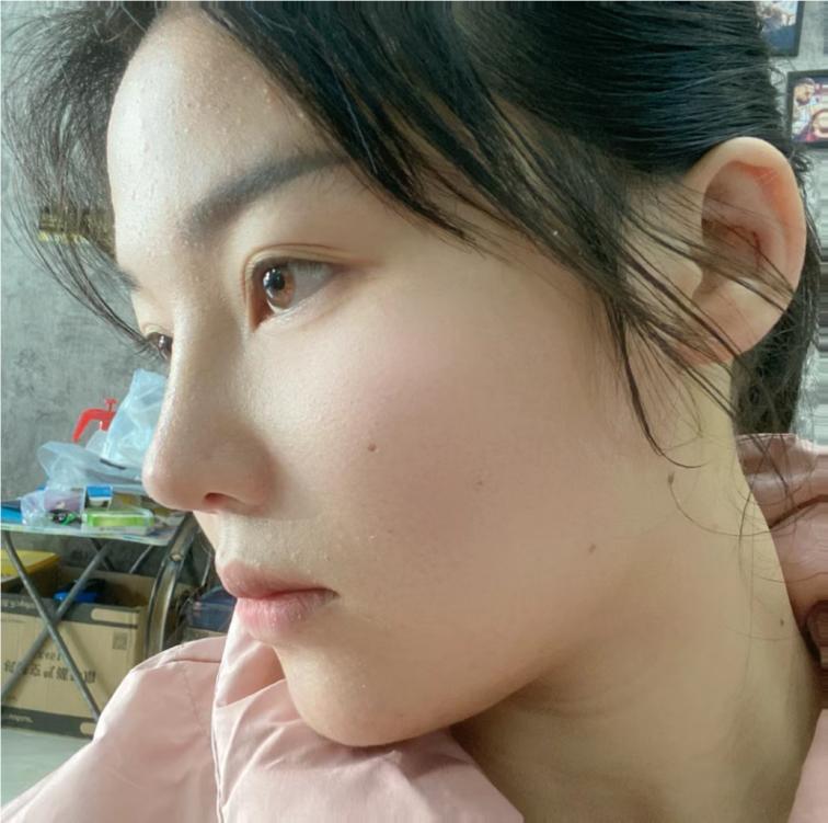 玻尿酸线雕隆鼻照片,做过线雕鼻的鼻子
