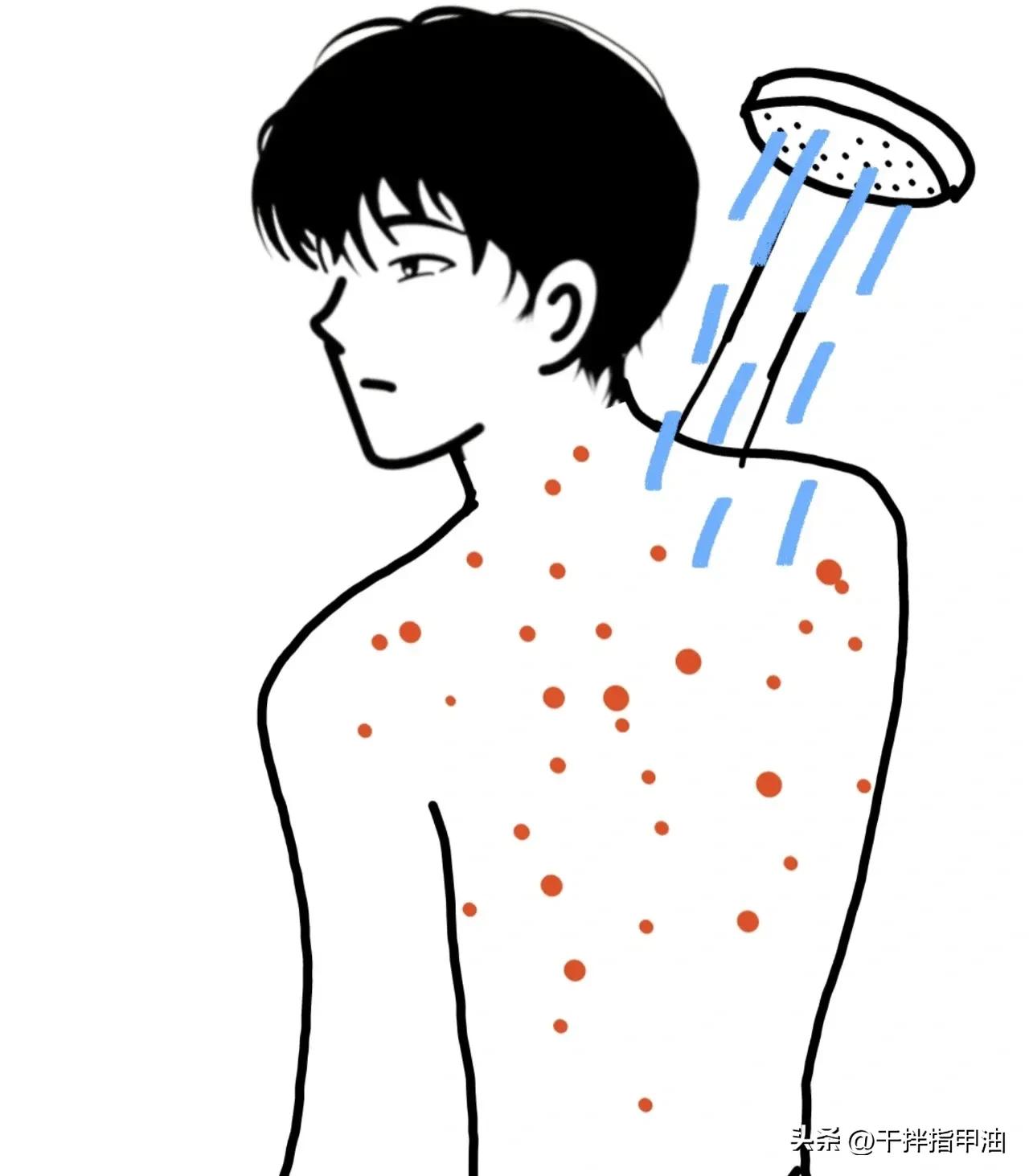 一到夏天背上手臂上好多痘痘,夏天一到身上就长痘痘