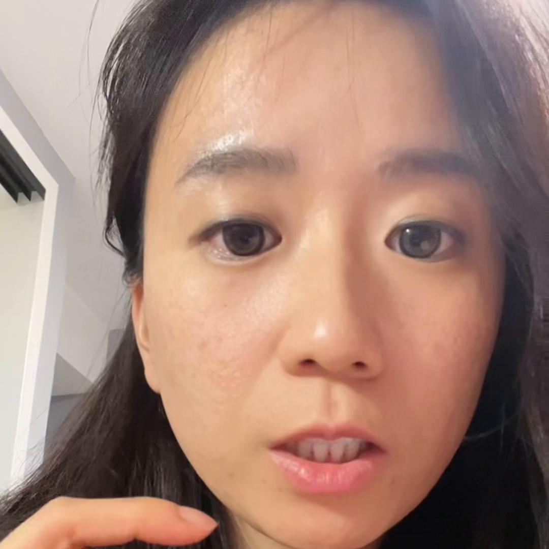 姐妹治好痘痘的视频,姐妹们广州治疗痘痘