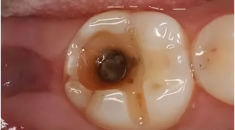 牙齿龋坏有什么严重后果吗,牙齿坏的危害