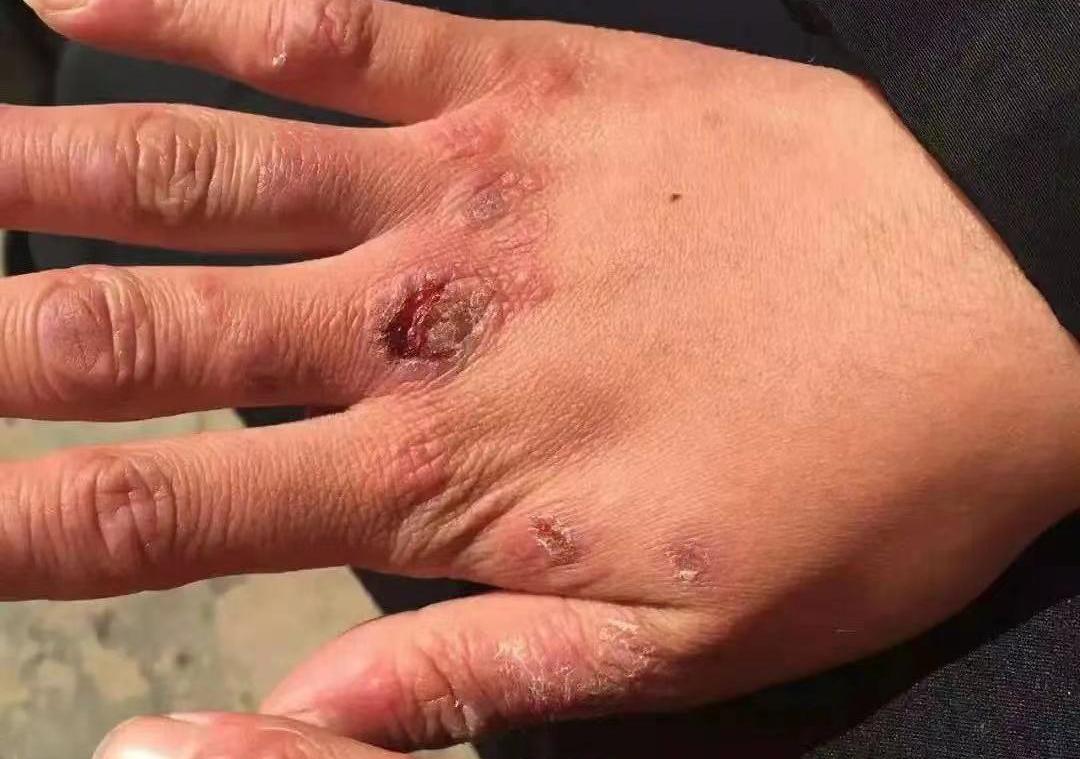 冬天手冻疮夏天怎么治,皮肤病冻疮怎么引起的