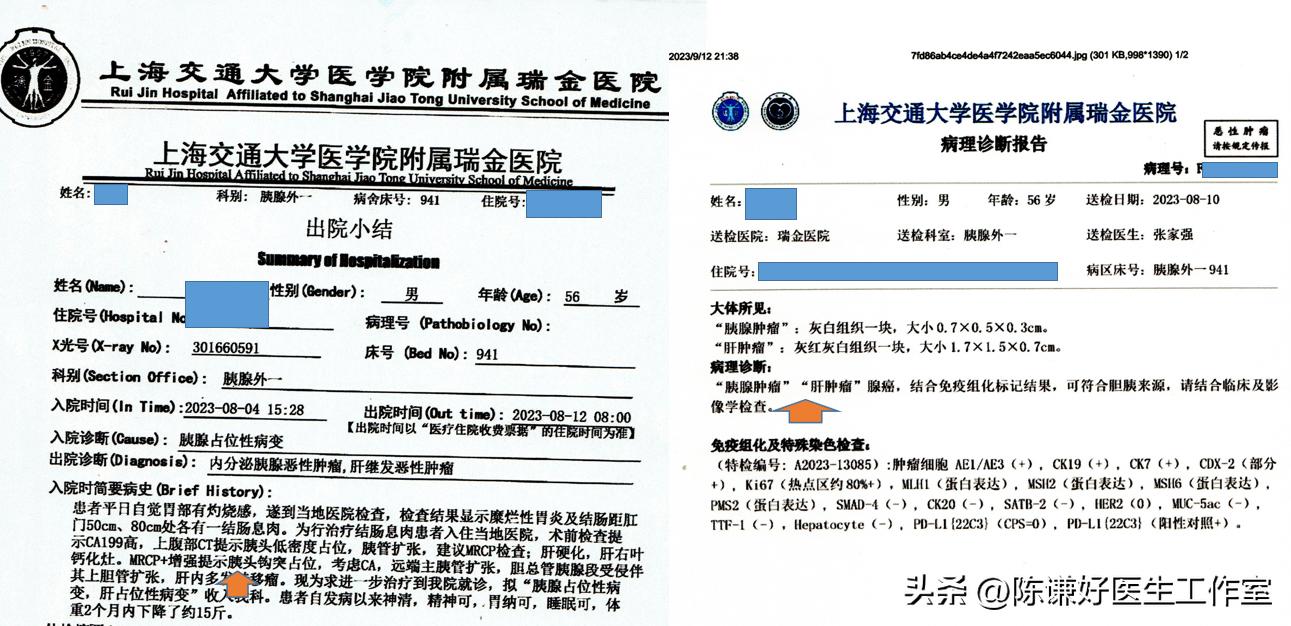 晚期胰腺癌肝转移海扶刀治疗病例（胰腺癌系列19015例）