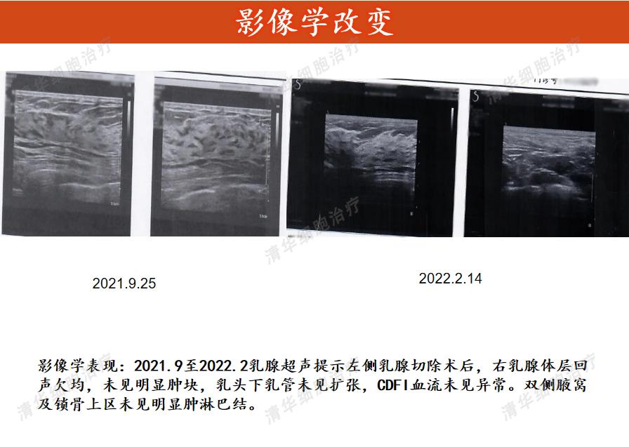 乳腺癌靶向药用后腰疼是什么情况,乳腺癌靶向治疗期间可以吃中药吗