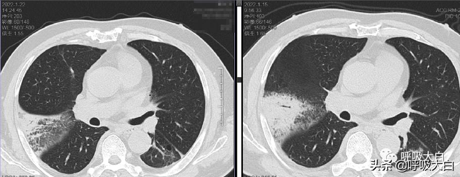 鹦鹉热病例分享,鹦鹉热怎么用药