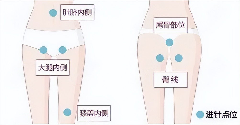 上海九院吸脂收费标准,九院韦敏面部吸脂