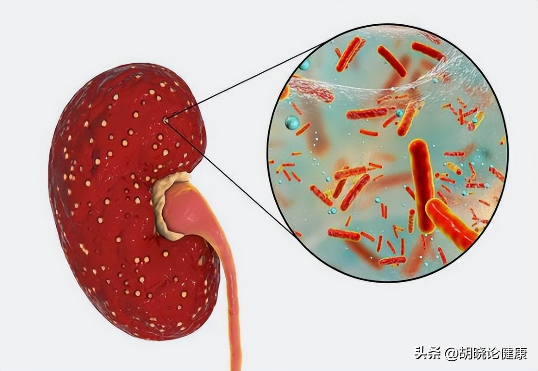 狼疮肾炎补体c4低是狼疮复发吗,狼疮性肾炎诊断的特异性抗体指标