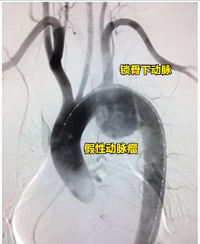 主动脉假性动脉瘤介入成功率,拆弹专家成功做手术