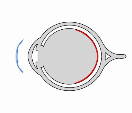 ok镜的优缺点及适应症,ok镜延缓近视的原理
