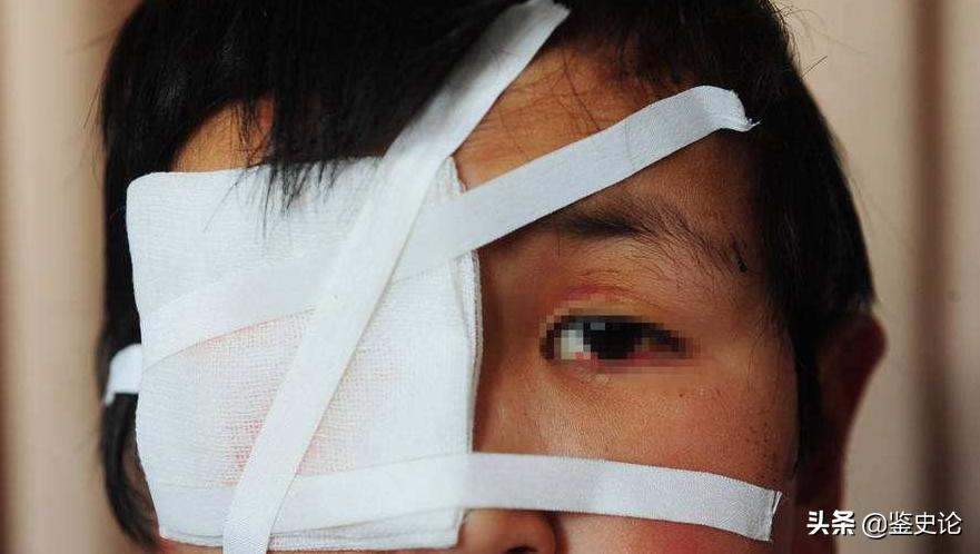 87岁老太右眼被打瞎,四川老太儿时射瞎双眼