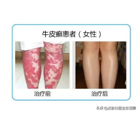 银屑病小腿红肿用什么药,银屑病关节肿痛怎么办