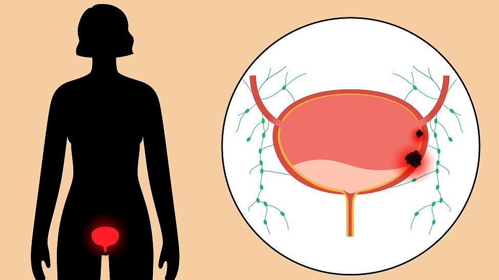 尿路感染不用怕七个家用小妙方,尿路感染吃什么中药彻底治愈