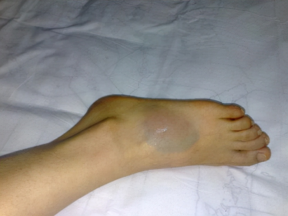 脚崴用什么药好得快,崴了脚什么方法最快痊愈