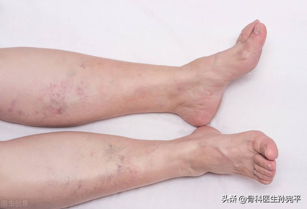 左下肢水肿的原因和治疗,儿童下肢水肿是什么原因