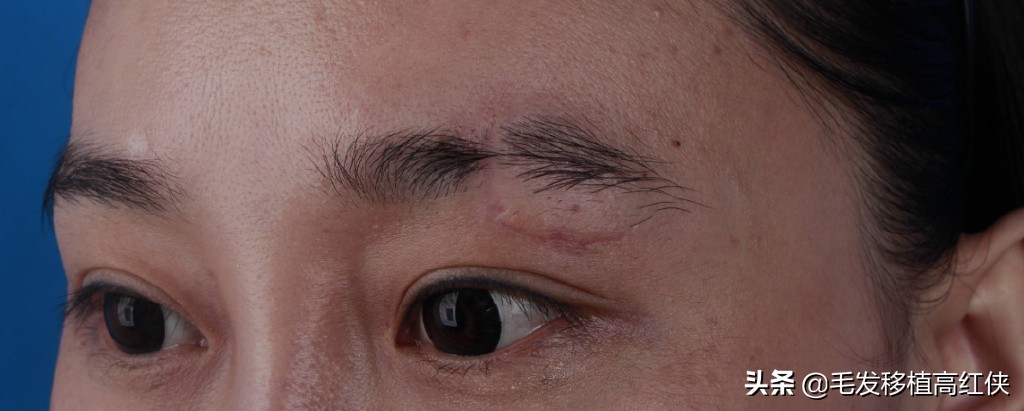 男人眉毛稀疏就要植眉,眉毛稀疏怎么植眉