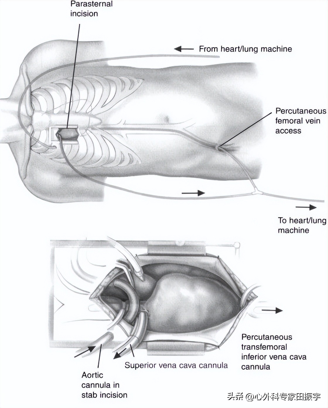 二尖瓣成形术要多少钱,二尖瓣成形术后抗凝多久