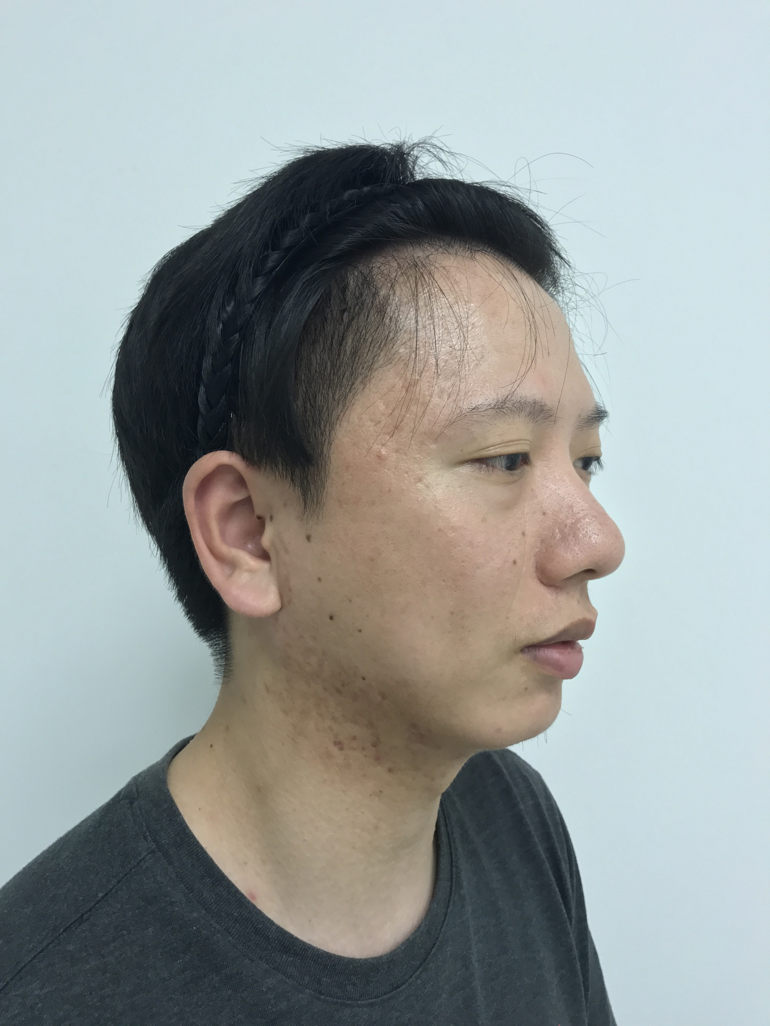 痘印痘坑做微针有效果吗,小伙子痘坑修复亲身经历