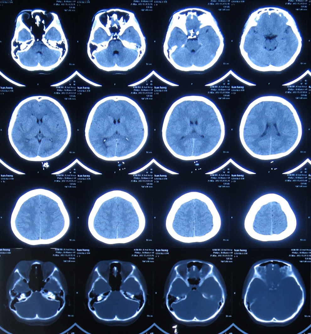 结核性脑积水能治愈吗,儿童结核脑膜炎脑积水