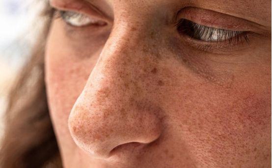 35岁皮肤暗黄有斑用什么护肤品,皮肤暗黄长斑吃什么药调理