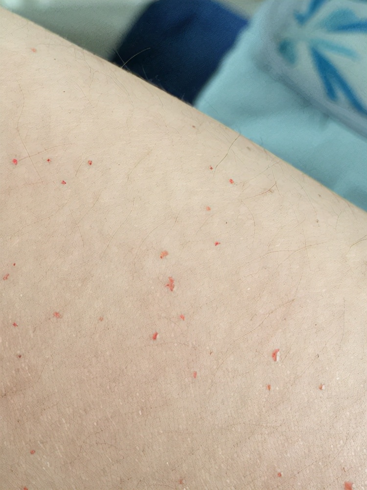 倪海厦讲白血病是阴虚还是阳虚,12岁女孩查出淋巴性白血病