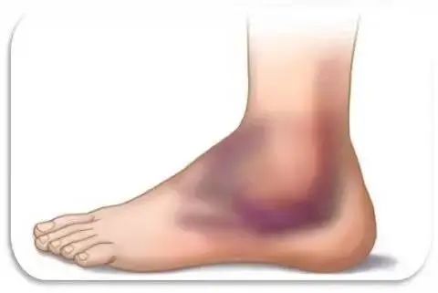 崴脚处理不当会成跛子吗,崴脚要紧吗