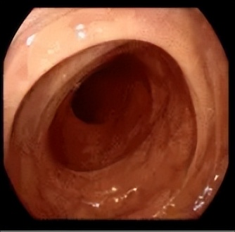 肠道准备不满意影响视野,肠道准备不充分肠镜会漏诊吗