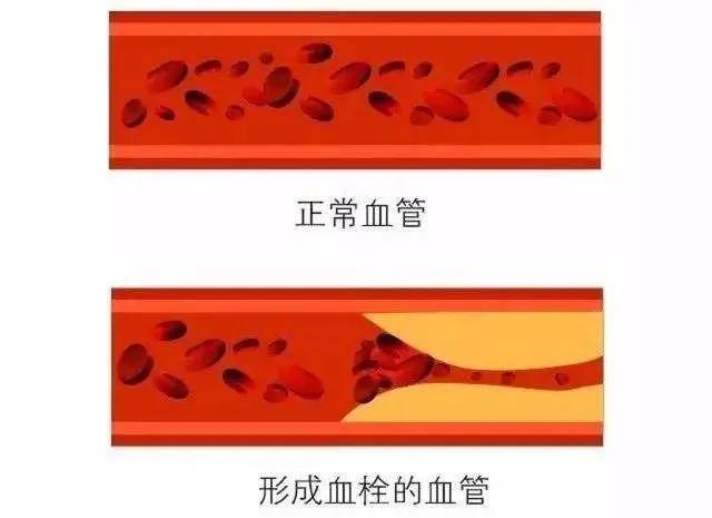 阿司匹林能溶血栓吗,溶血栓阿司匹林