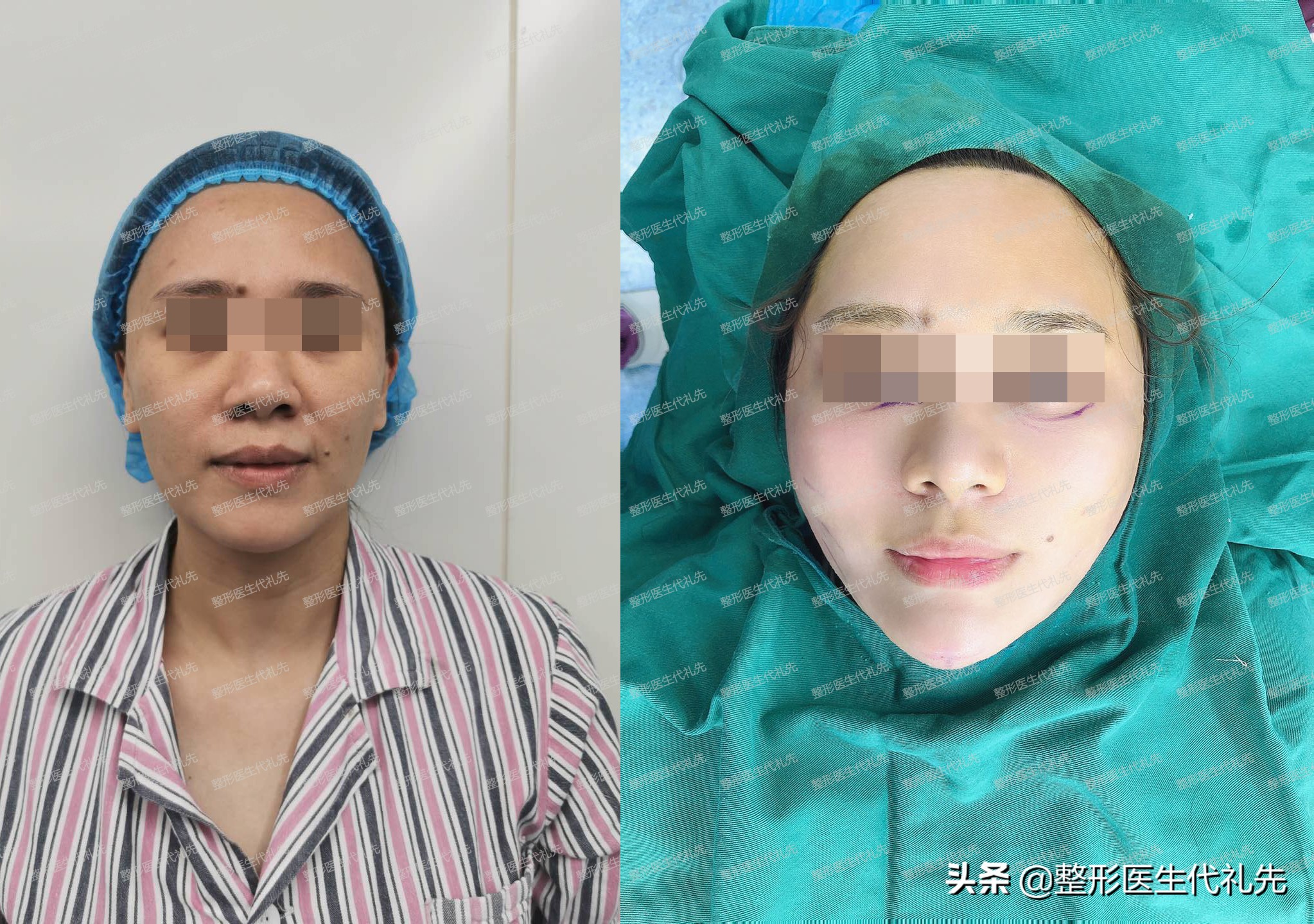 筋膜层脂肪层真皮层,真皮层和筋膜层之间的脂肪层