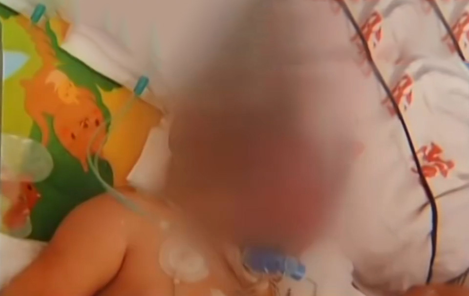 男孩因为烧伤惨遭毁容,被烧伤毁容的男孩