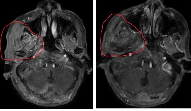 老年人癌症免疫治疗,老年人能打免疫球蛋白吗