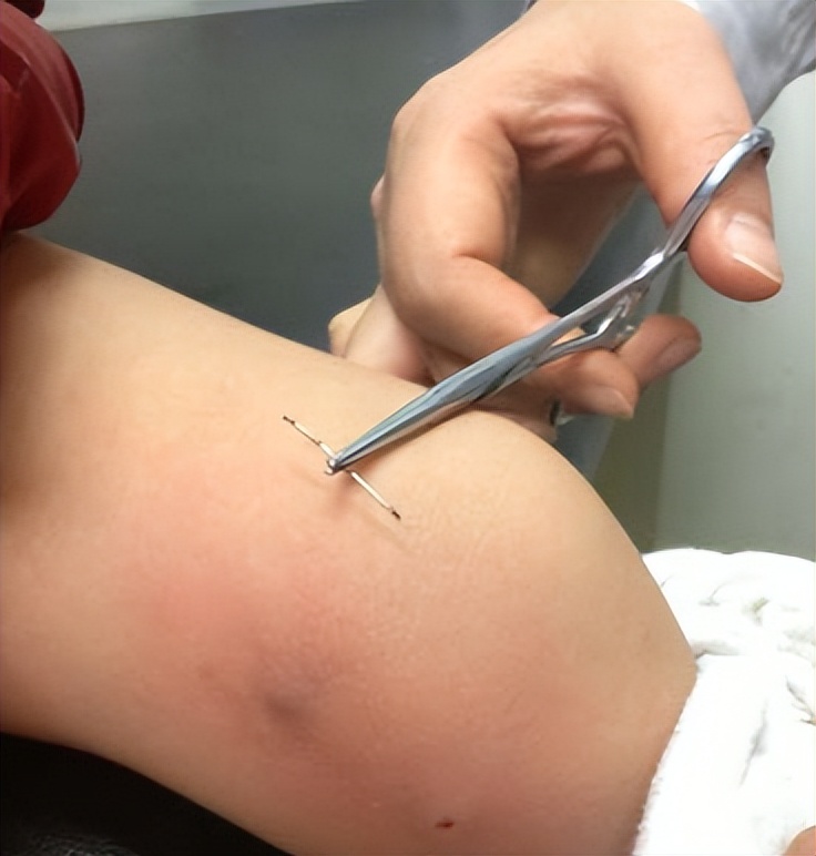 女幼童外阴红肿疼痛,女幼童外阴红肿疼