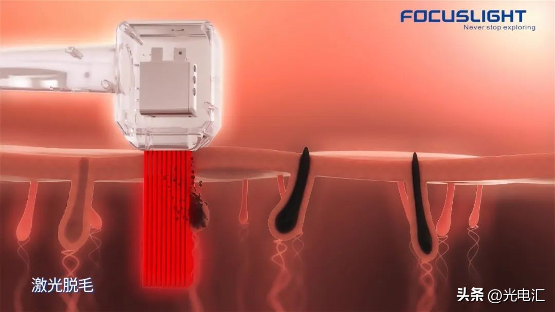 半导体激光脱毛产品技术要求,半导体激光脱毛仪能产生什么效益