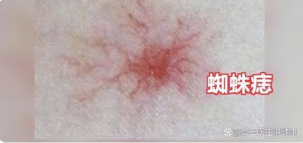 肝病皮肤出现蜘蛛痣有多严重,蜘蛛痣是肝病早期出现吗