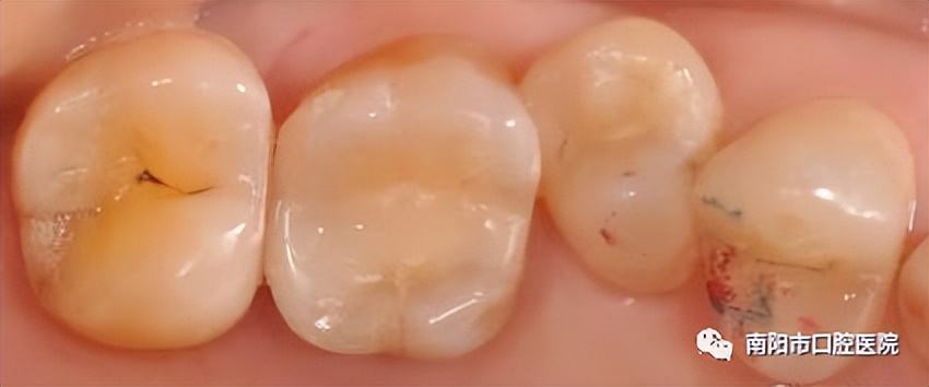 医生问你牙怎么这么不好,医生说我的牙齿裂开了怎么治疗