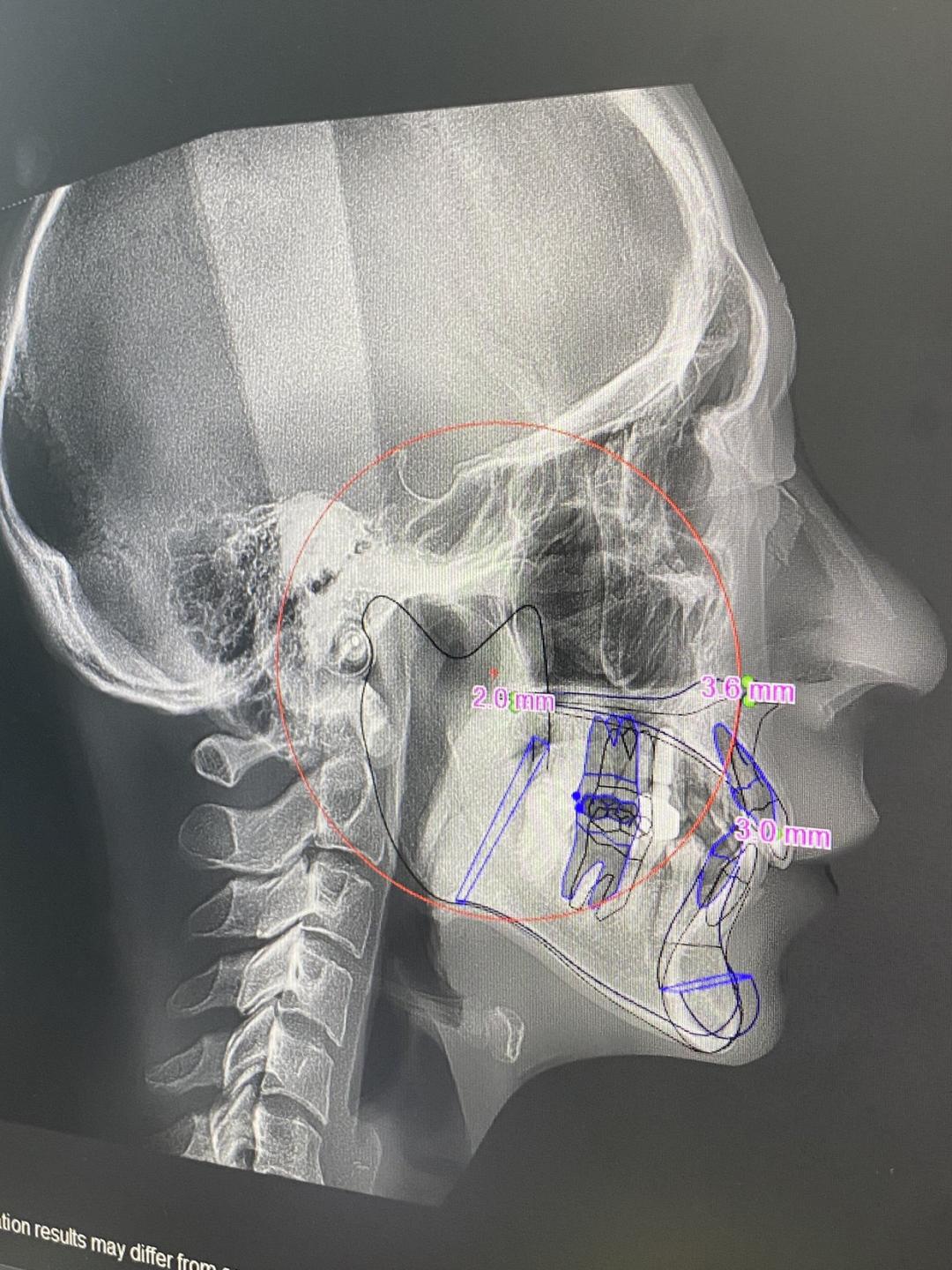 日本1米5小哥砸1600万疯狂整容增高！断骨惨烈过程吓傻网友