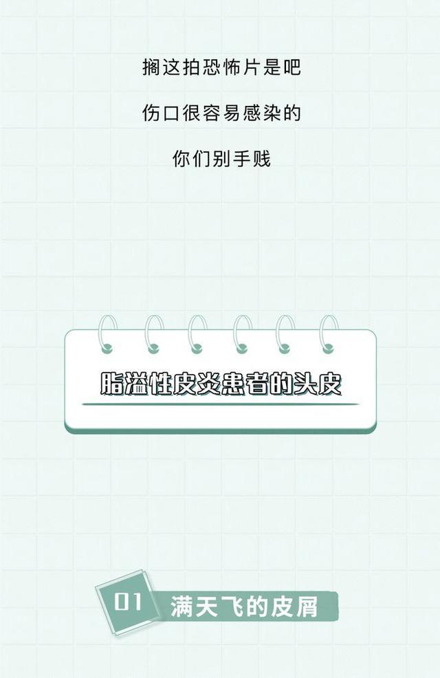 头皮内抠出白色颗粒状东西是什么,头皮上白色的小颗粒可以抠下来