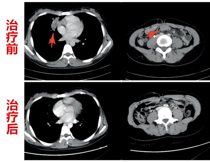 双胞胎癌症宝妈,双胞胎宝妈抗癌