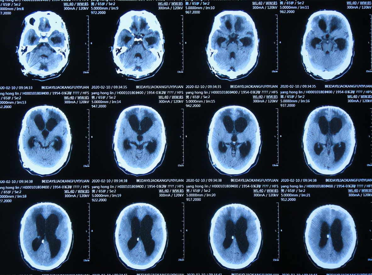 脑外伤后硬膜下积液颅骨修补,颅骨修复手术失败导致脑积水