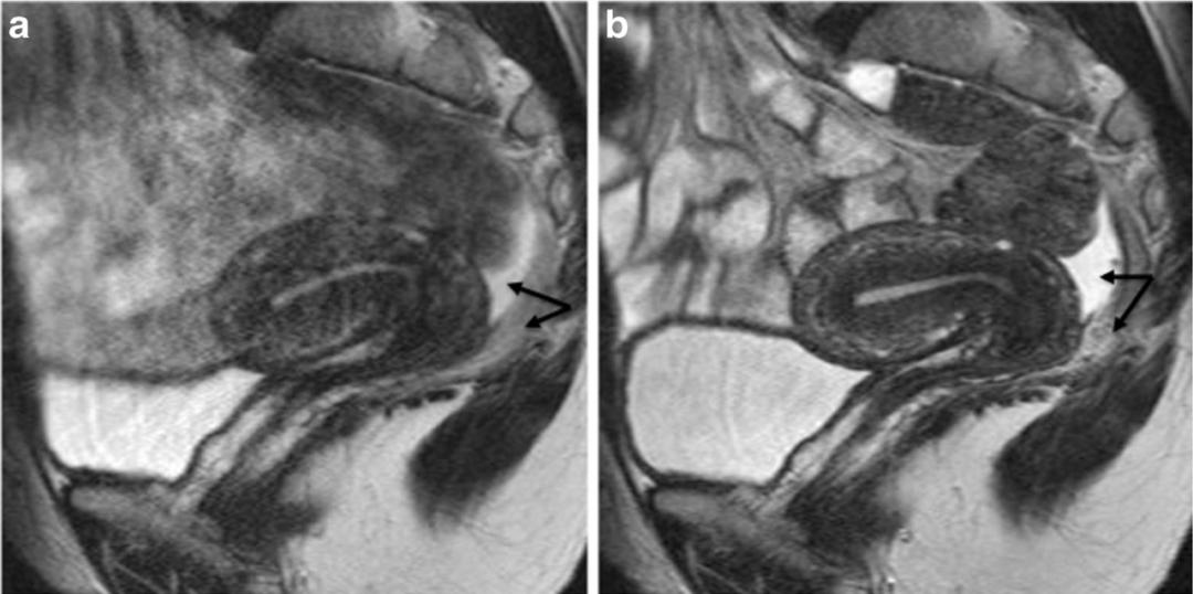 MRI如何评估子宫内膜异位症？这10个病例会帮助您