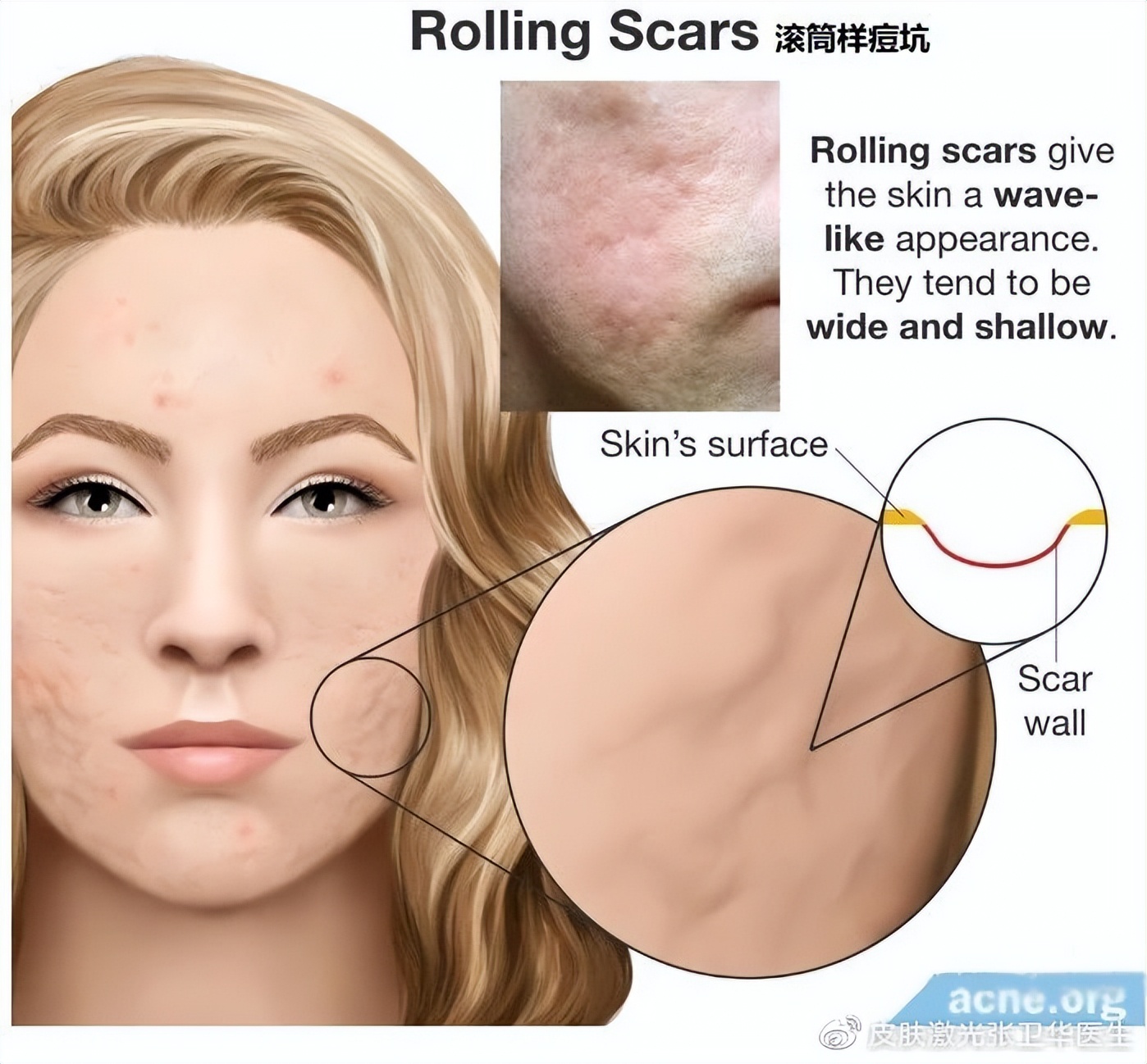 痘印痘坑要怎么去掉才能不留疤呢,为什么你脸上会长痘痘