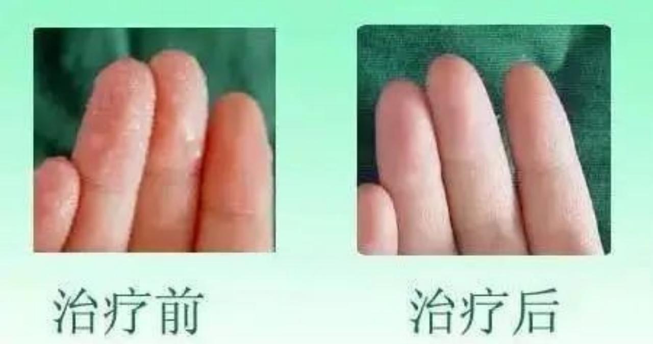 手心出汗是怎么回事怎样治疗,手汗症出汗特别严重用什么能止汗