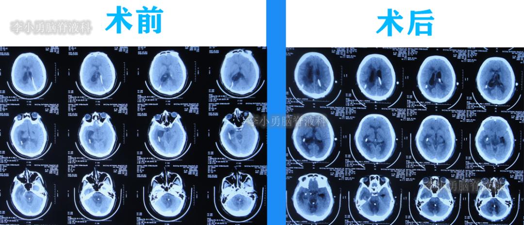 脑积水三脑室造瘘多久能恢复,脑囊虫手术后脑积水
