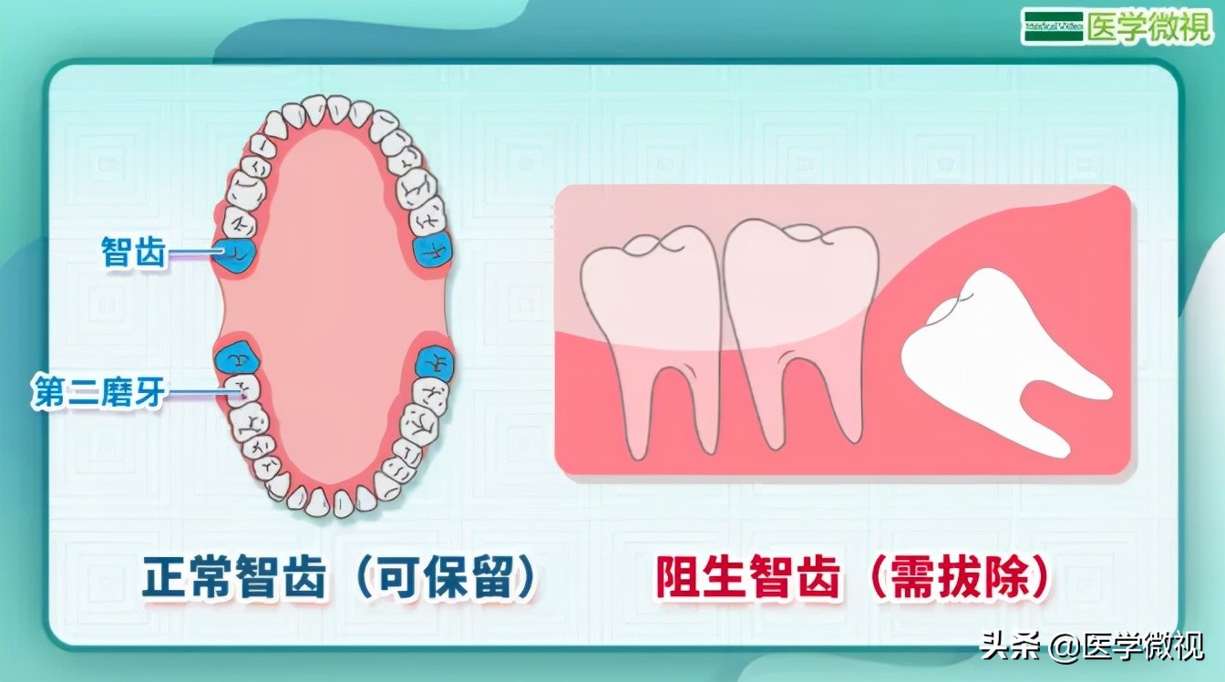 智齿摇晃厉害可以自己拔吗,拔智齿是硬把牙拽下来吗